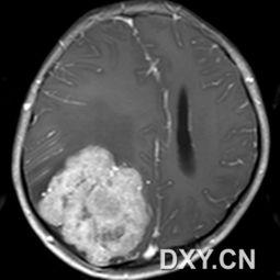脑肿瘤图片,形态、特征与诊断要点
