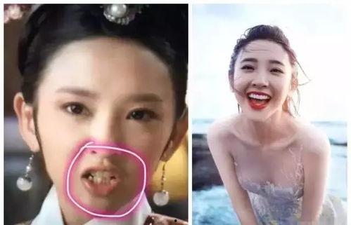 整过的牙的明星